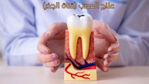 علاج العصب (قناة الجذر): دليلك الكامل لإنقاذ السن وتسكين الألم