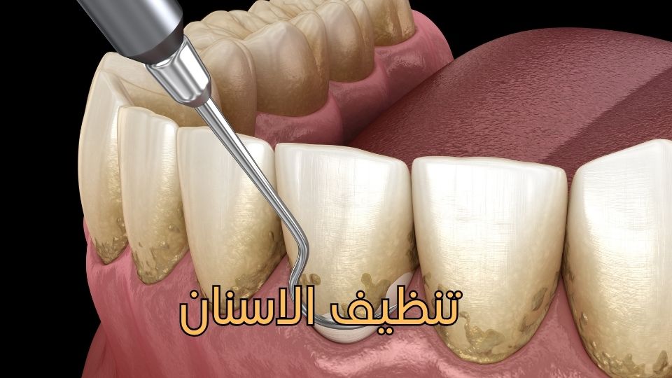 علاج العصب (قناة الجذر)-1
